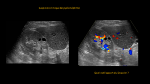 Question Pyélonéphrite