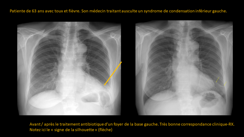 Réponse Thorax