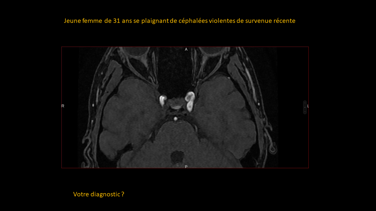 Question Anévrysme