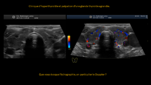 Question thyroide