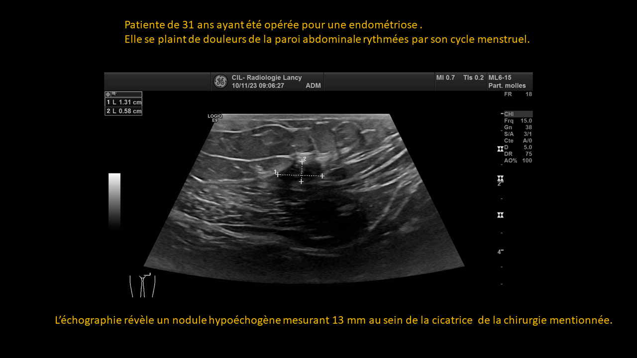 Question endométriose