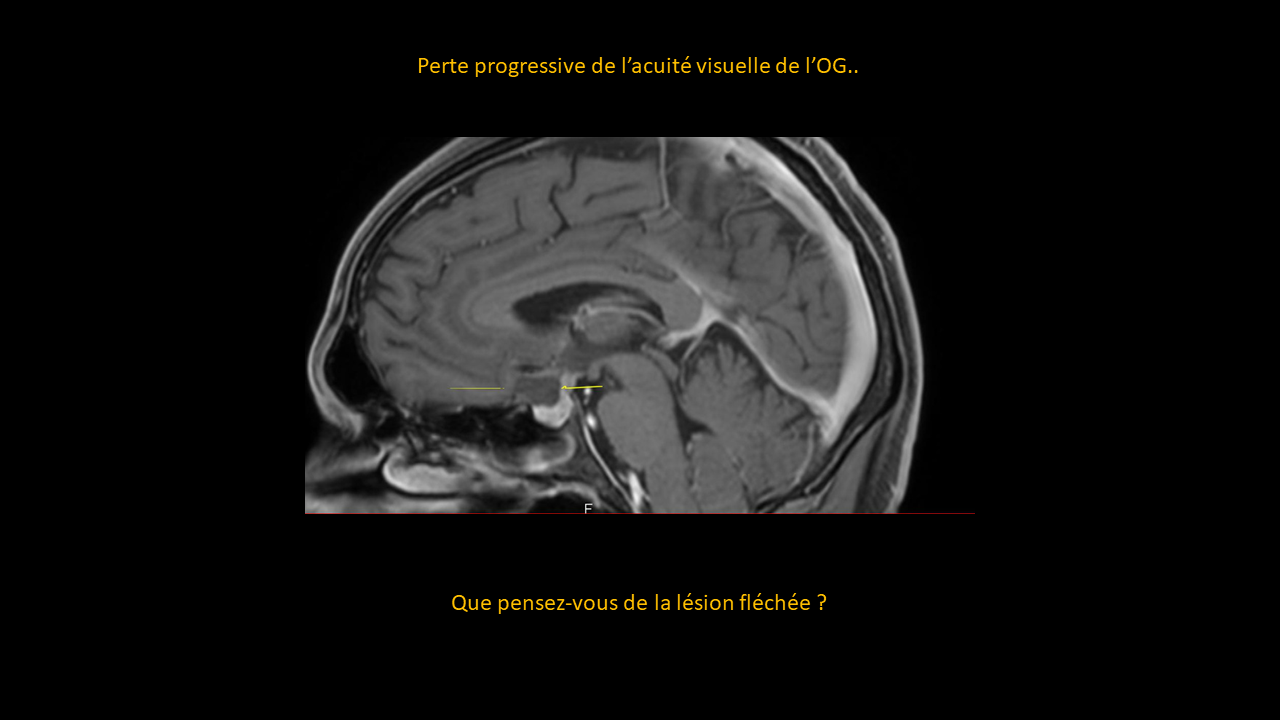 Question cranyopharyngiome