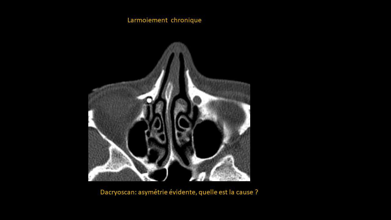 Question nasal