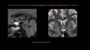 Question Cranyopharyngiome