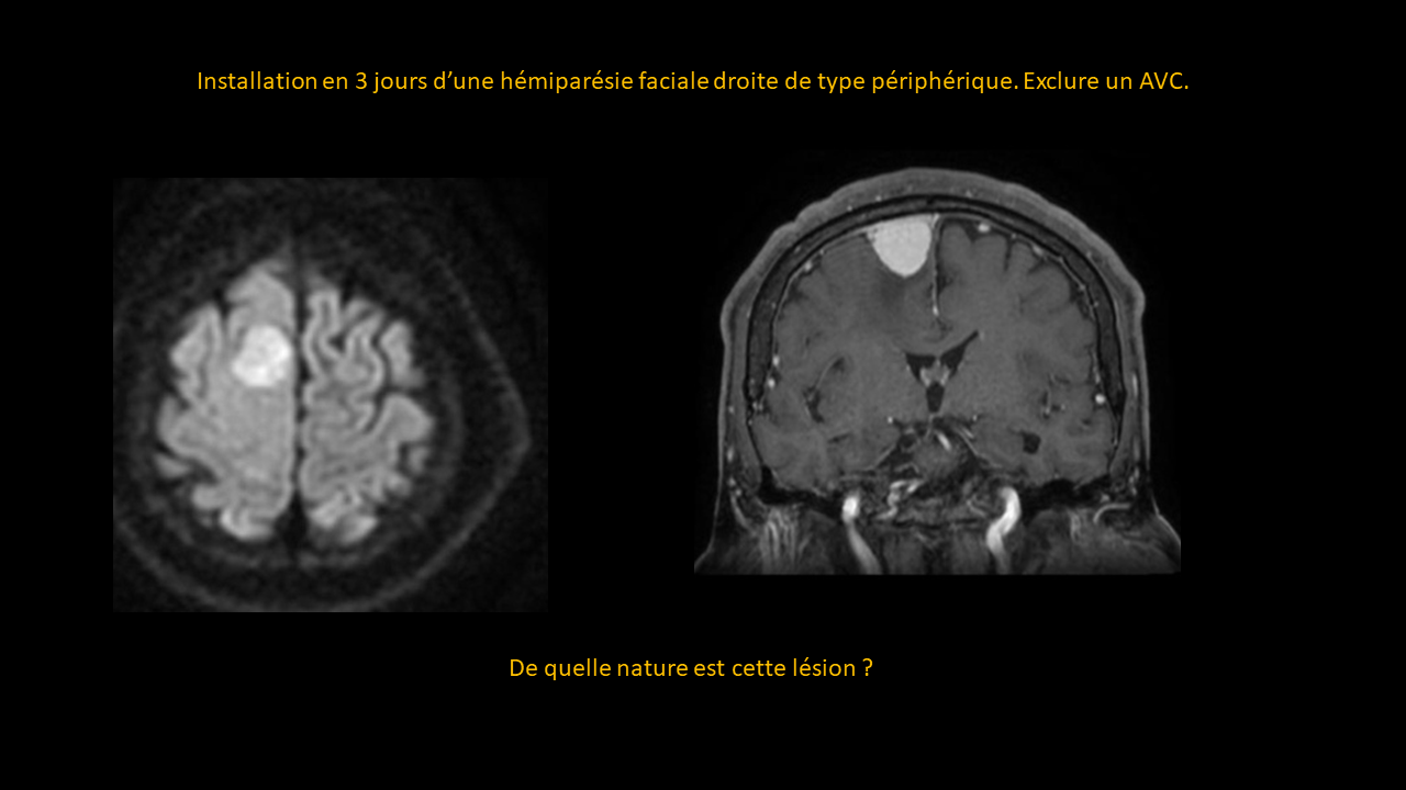 Question méningiome